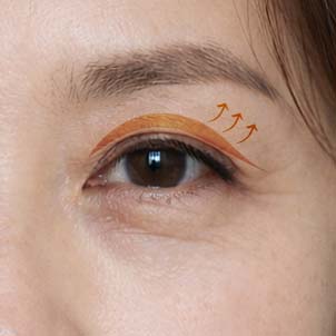 처진 눈꺼풀 리프팅 