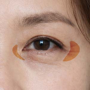 눈가 주름 개선