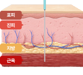 일반 보톡스