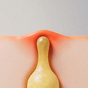 염증 반응 감소